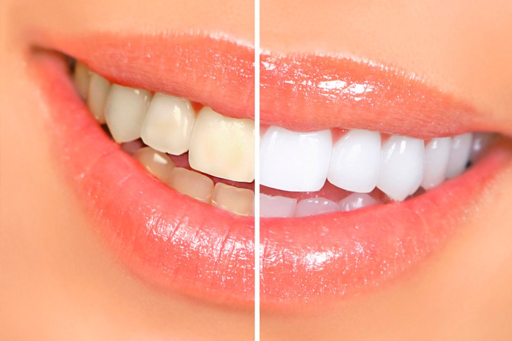10 informações sobre clareamento dental que você precisa saber
