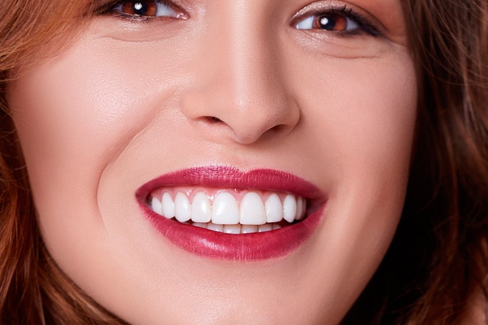 Como mudar o seu sorriso com lentes de contato dental
