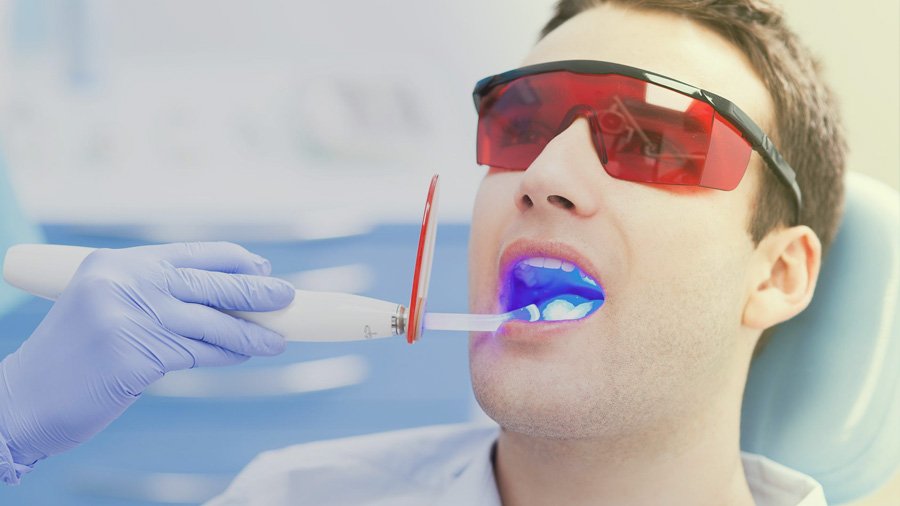 Clareamento dental profissional a maneira correta de deixar seus dentes brancos