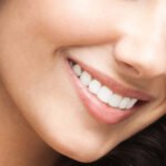 5 dicas para conservar suas facetas ou lentes de contato dental