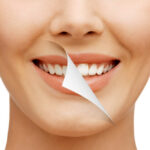 Lente de contato dental ou clareamento qual a melhor opção