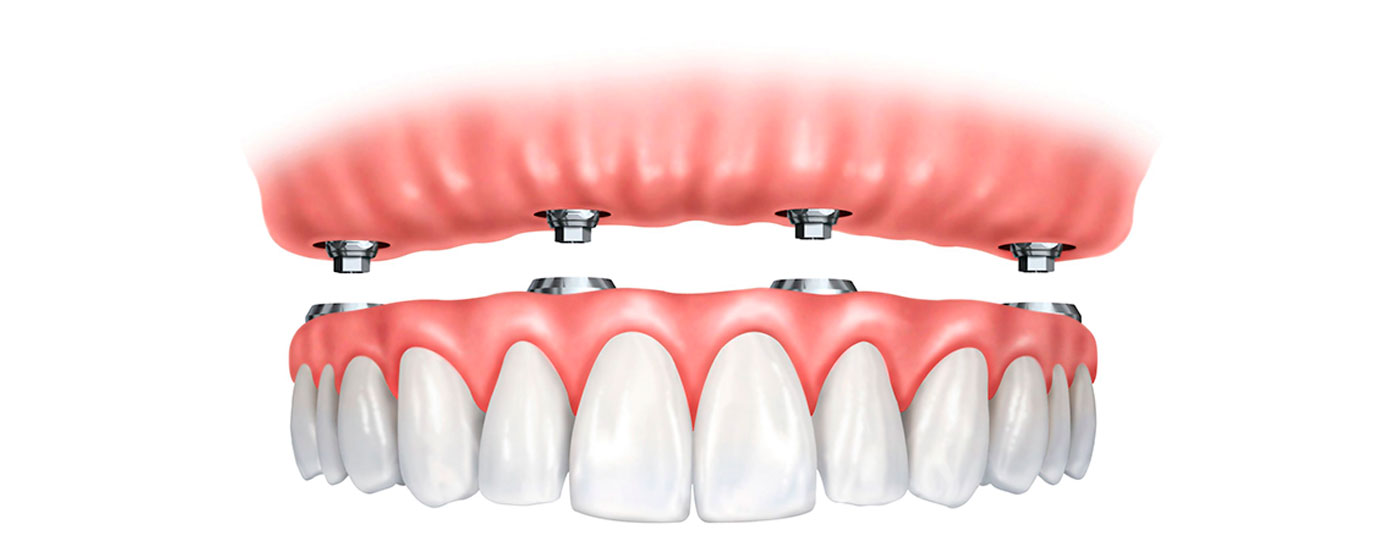 implante dentário prótese protocolo joinville