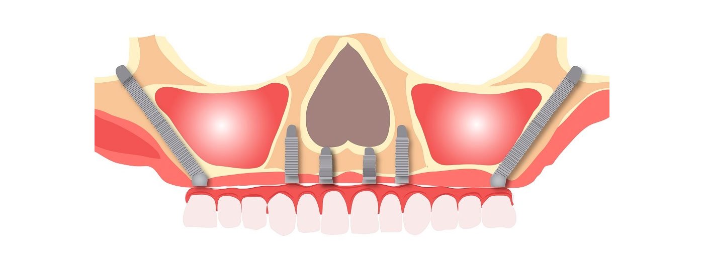 implante dentario zigomatico joinville